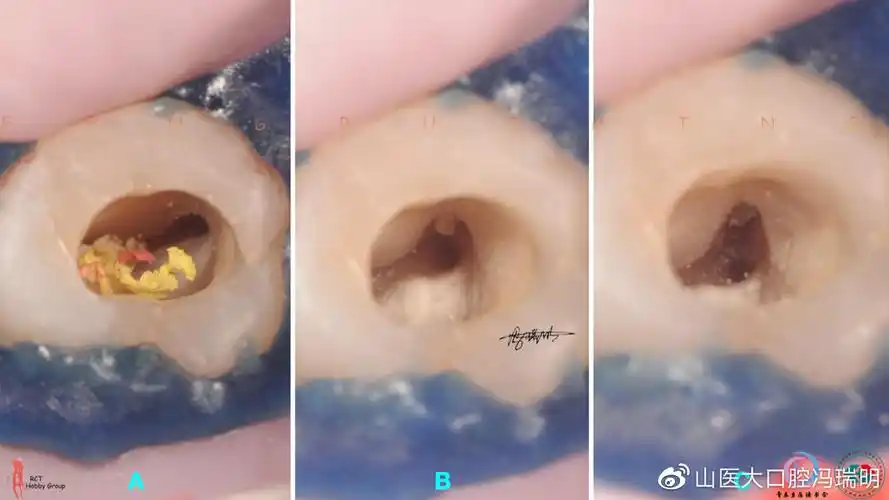 上颌第二磨牙根管解剖形态特点及病例分享