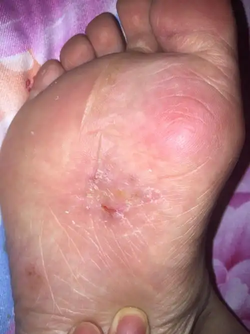 脚掌这里一到夏天就很痒 怎么回事?擦药也没用