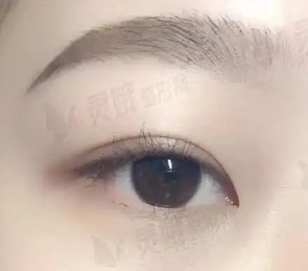 一,平行开扇型双眼皮图片