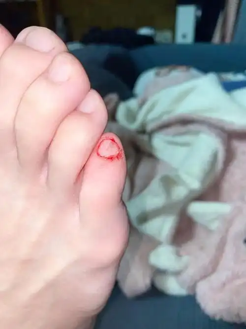 真是服了 翻车手还没好 今晚脚又被门撞出血9191