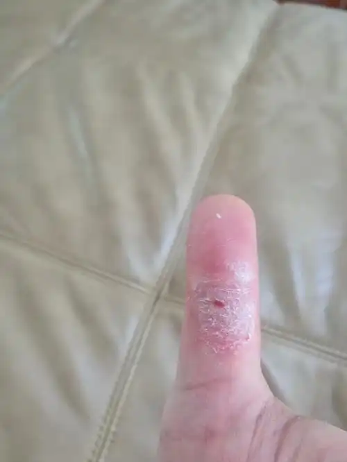 左手大拇指关节内侧一到秋天就蜕皮