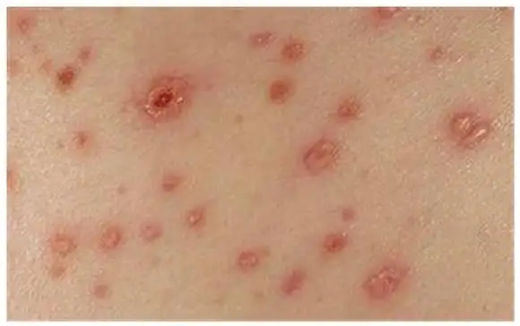 红斑狼疮早期症状,湿疹和该症的对照图,轻度是什么样?