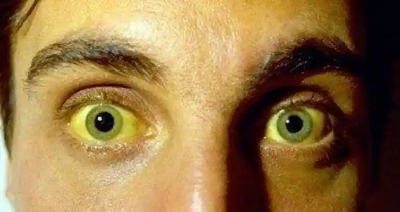 黄疸是血清中的胆红素升高引起皮肤,黏膜,巩膜等黄染的症状和体征.