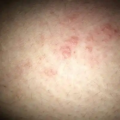 湿疹后期有什么症状