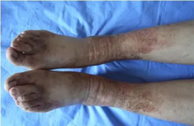 老年人鱼鳞病如何护理