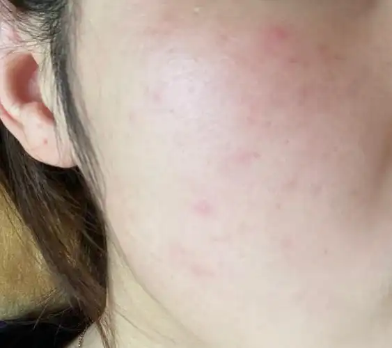 脸上有泛红有红血丝敏感肌肤下怎么办