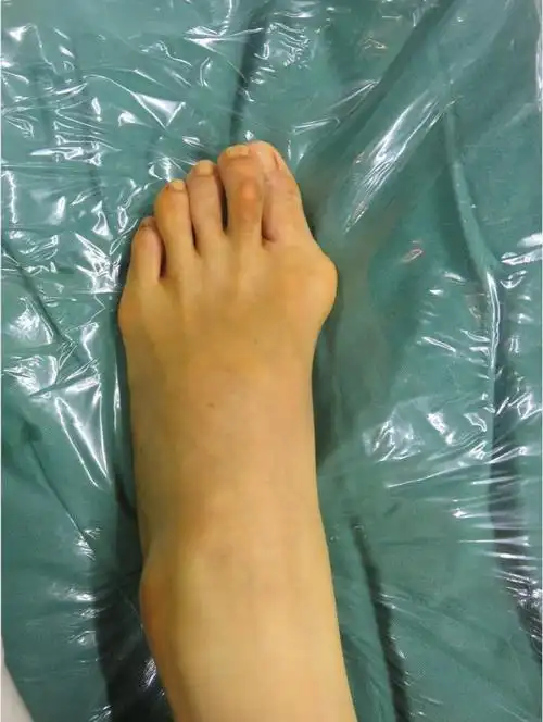 拇外翻_手术_治疗方法_治疗方式 - 好大夫在线