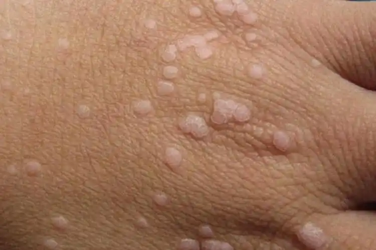 12种疣体图片和介绍