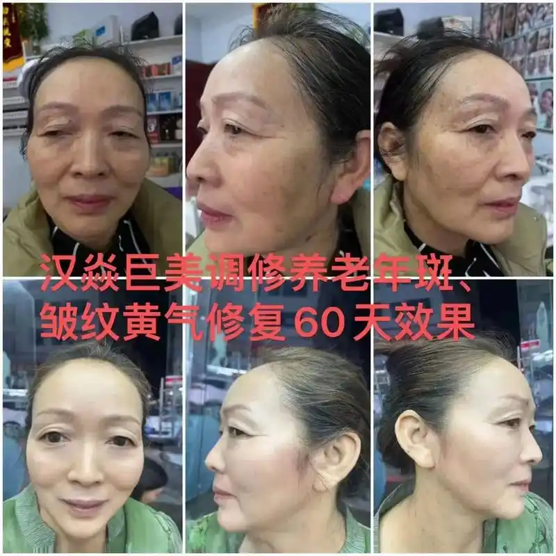 来一组汉焱前后对比照15到20天出效果汉焱抗衰紧致皮肤逆龄锁龄解决