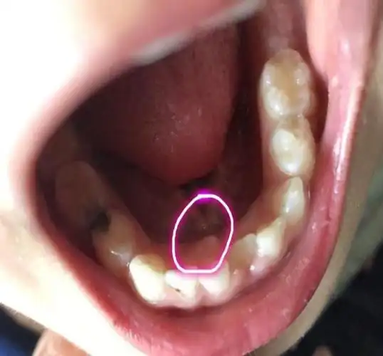 7岁男童长出双排牙医生跟吃的东西有关