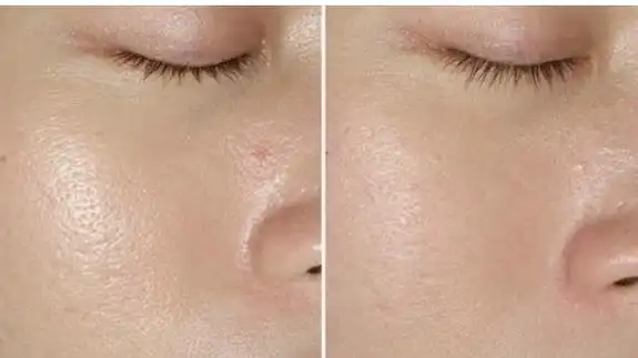 毛孔粗大如何改变