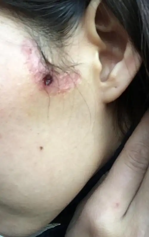 做了个小手术,结果没注意好,发炎了!请问现在伤口这样还在发炎吗?