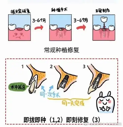 种植牙##天津市中幸口腔医院##常规种植##即拔即种##即刻种植