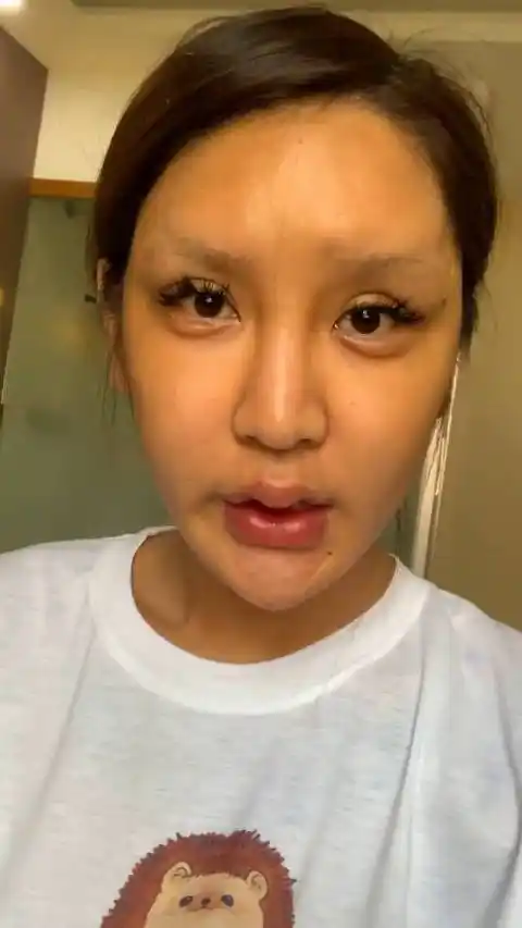 整容后遗症,太可怕了