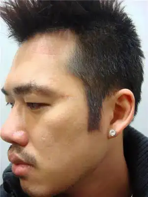 鬓角植发技术特别好