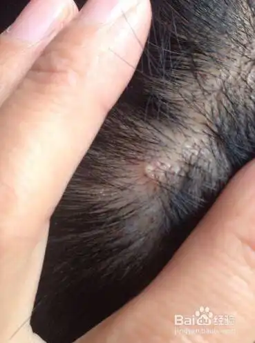 头痒有小疙瘩怎么办