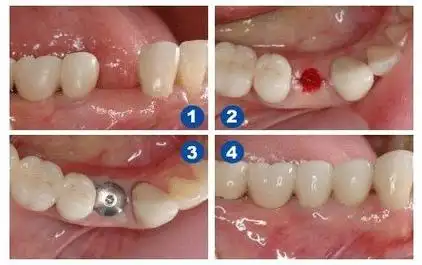 温州建国口腔医院种植牙好不好?