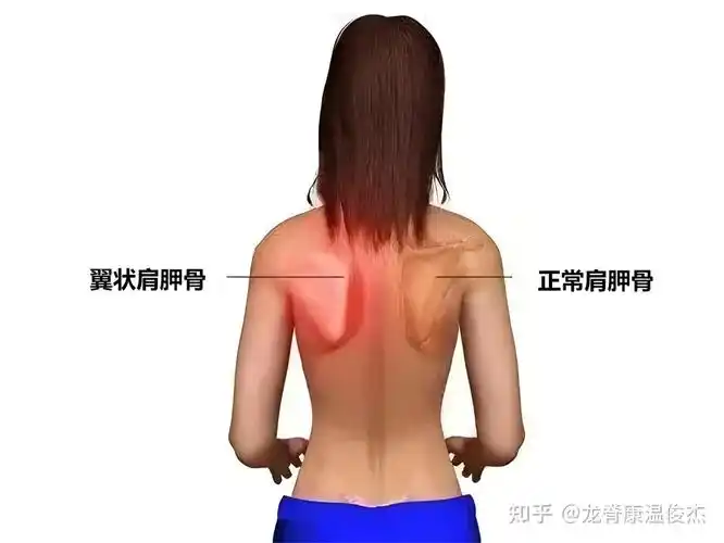 斜方肌大,富贵包等不良体态,是哪些原因造成?如何正确消除?