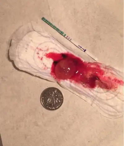 流产掉下来的孕囊图片 (21)