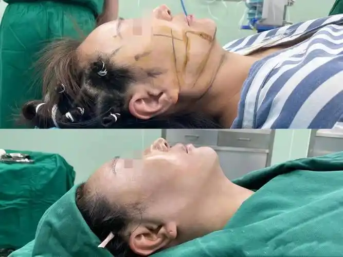 事实的真相如何?拉皮手术谣言大揭密,我只说一次!_进行_医生_表情