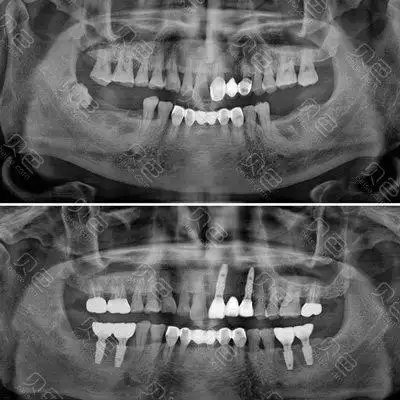 种植牙术前术后拍片对比