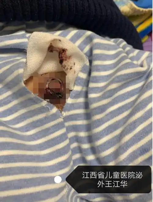 图四,五,六,都是术后常见情况,因为术后切口缘会有少许渗出液,混合