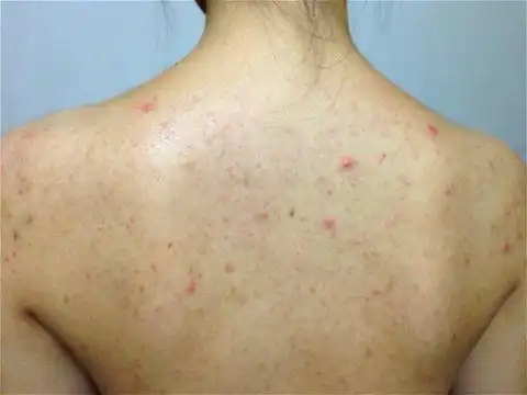 长痘痘和螨虫有关系吗