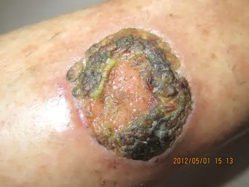 请问有谁看过这种皮肤病有点恶心