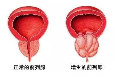 "零出血"解决前列腺增生