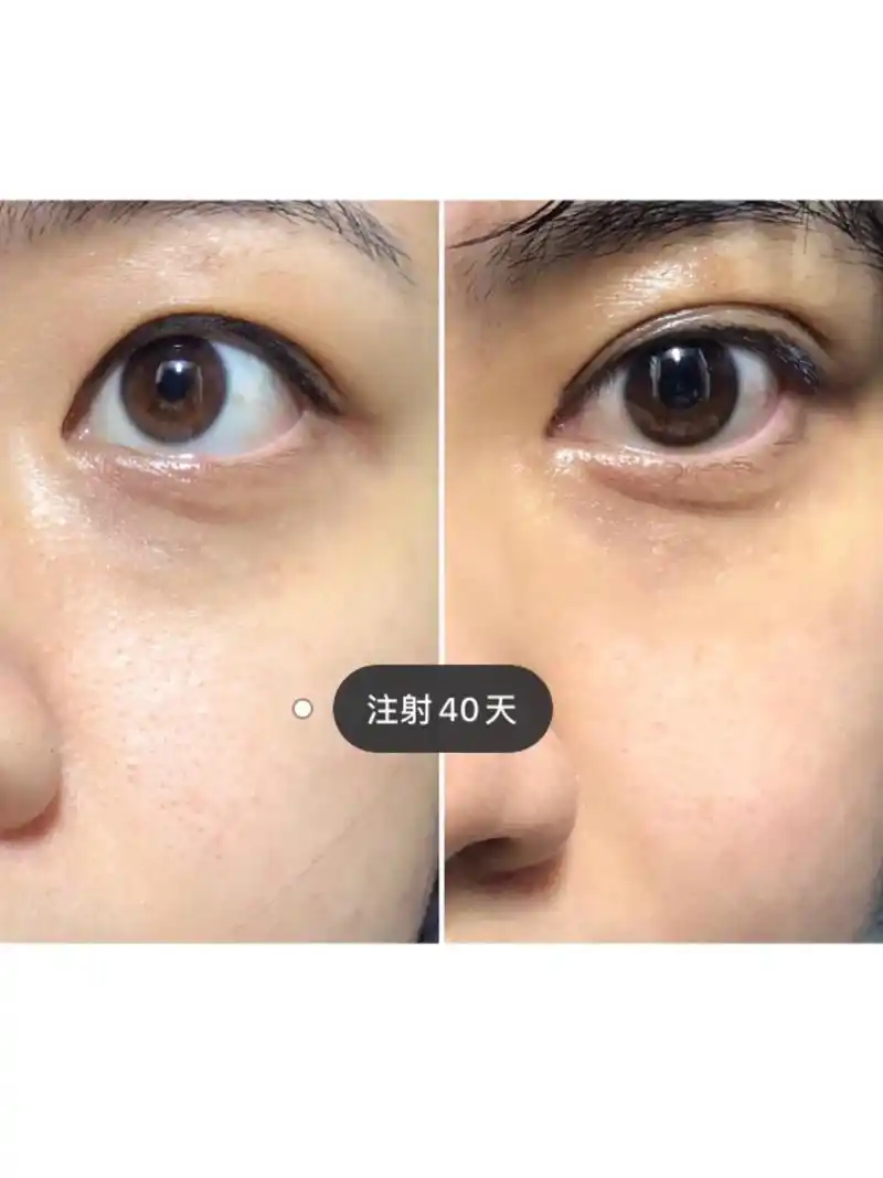 嗨体填充泪沟和眼窝的效果如何呢?