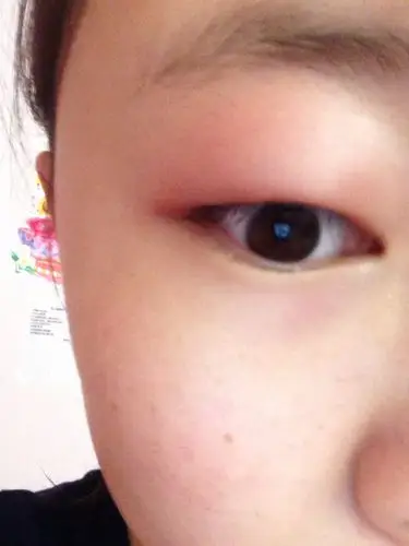 眼睛肿了个包,怎么办?