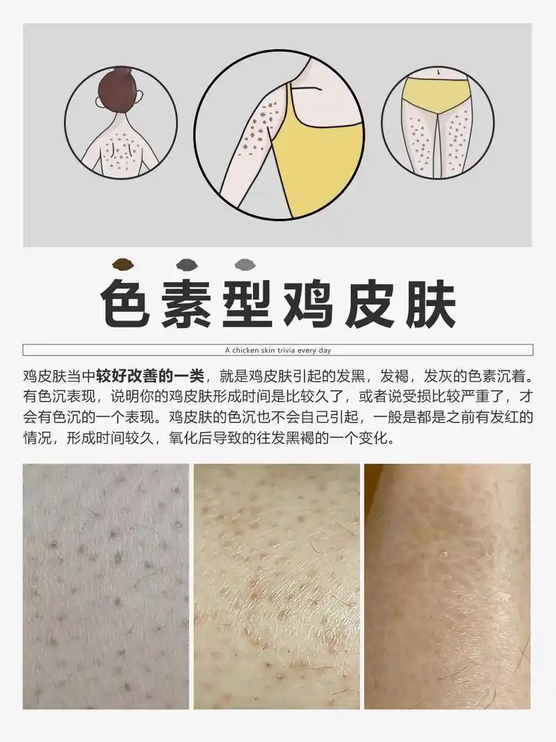 你是属于哪种鸡皮肤?#毛囊炎 #鸡皮肤 #鸡皮肤救星 - 抖音