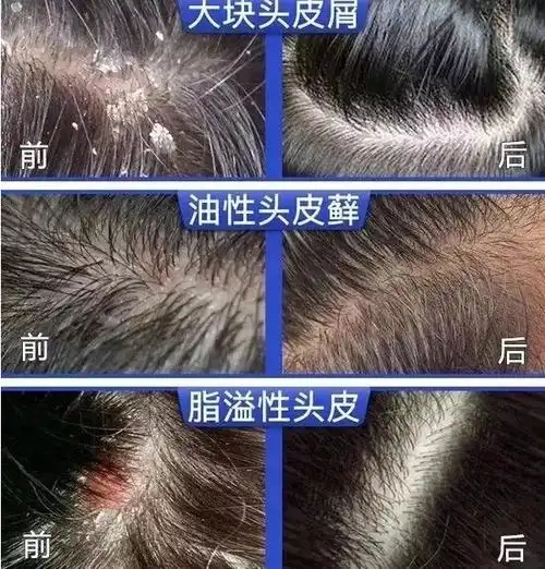 男女通用去屑洗发水推荐_头皮屑_头发_问题