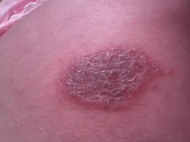 怀孕八个月了,几个月前肚子上长了一片东西,小手