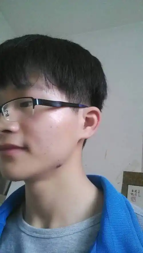 下巴有痣好不好?