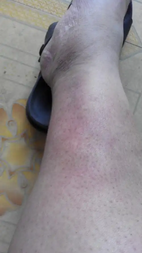 我两个小腿下端发红发痒,按压头疼痛感,天气热了症状轻一点