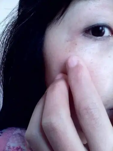 请问眼角下边是什么班,是怎么引起的,有办法消掉吗?