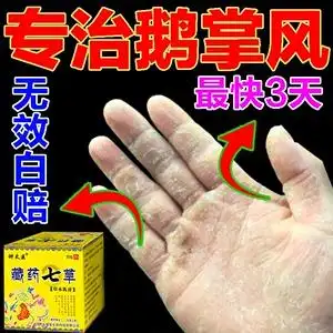 手藓药膏鹅掌风
