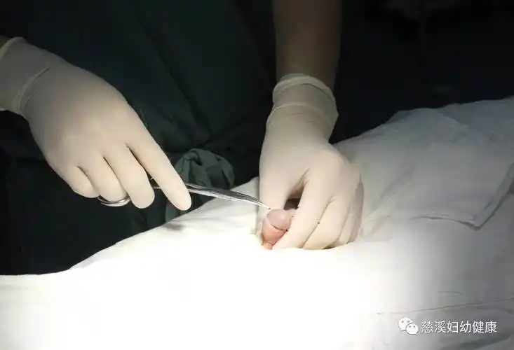 关注暑期迎来小儿包皮手术高峰哪些小朋友需要修理小jj