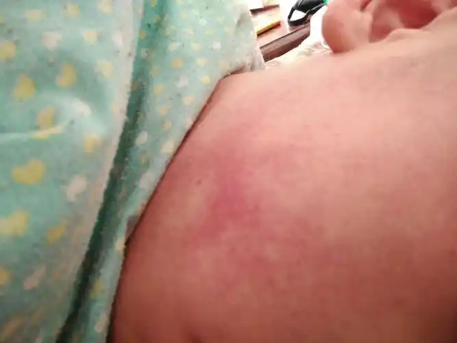 脸部毛细血管破例怎么治疗啊