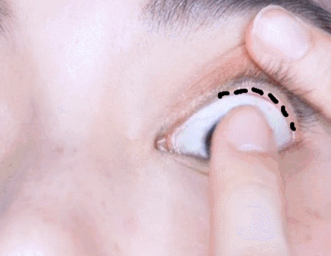 在内眼睑的位置,睫毛根部之下,靠近眼球的眼睑.