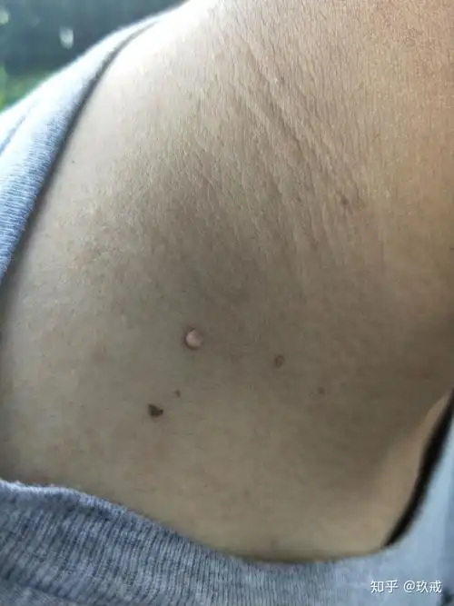 谁知道脖子上长个肉是怎么回事