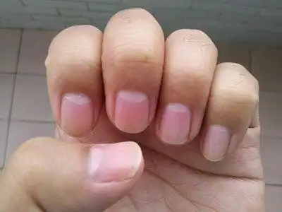 正常指甲的颜色