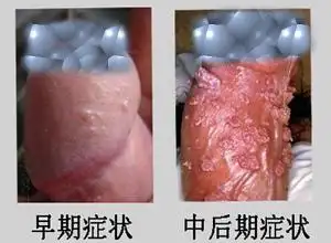 男科 珍珠丘疹珍珠丘疹概述    珍珠丘疹是在阴茎的冠状沟处环绕龟头