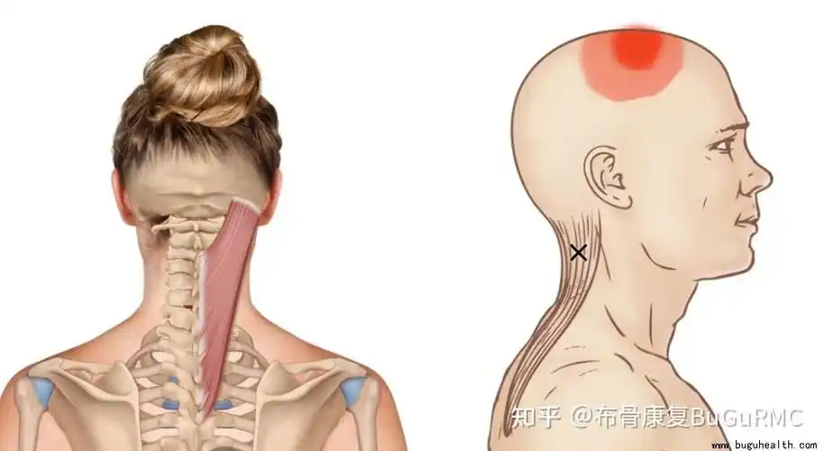 头夹肌容易受寒冷刺激,导致肌肉僵硬和酸痛.头夹
