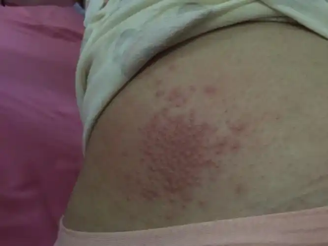 刚生完孩子子一个星期,现在坐月子,大腿外侧两边长了这个小红子怎么