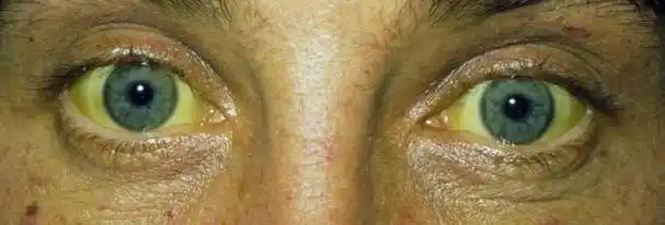 胆色素的代谢障碍,则会出现肝细胞性黄疸.