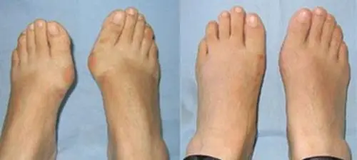 拇外翻患者双脚术前术后对比图片