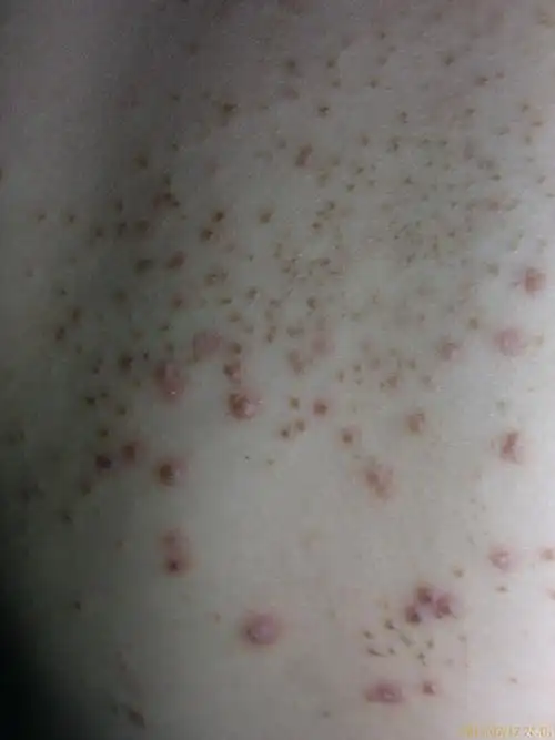 看图识病马拉色菌毛囊炎三天治愈