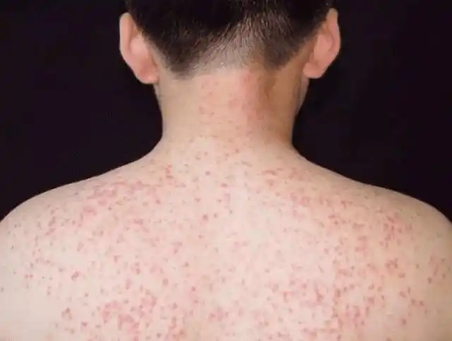 背后长的红疙瘩,是痘痘还是毛囊炎?为什么总是去不掉?